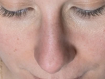 Photographies pour rhinoplastie et chirurgie maxillo-faciale à Toulon